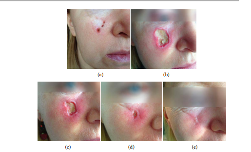 cancer de pele rosto fotos